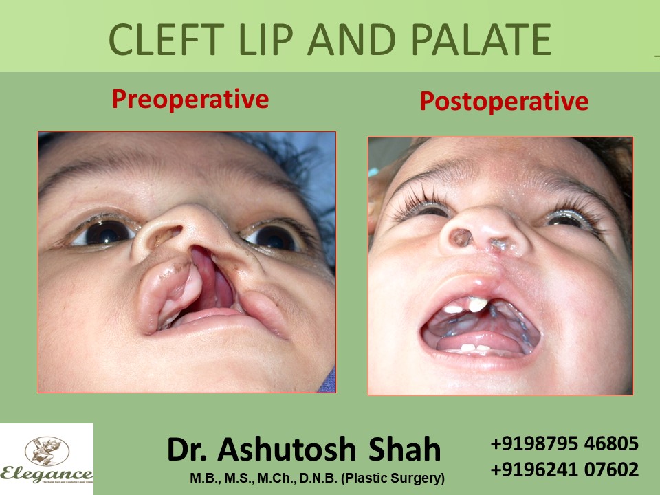 CLEFT LIP AND PALATE Treatment, Valsad, Gujarat, India.