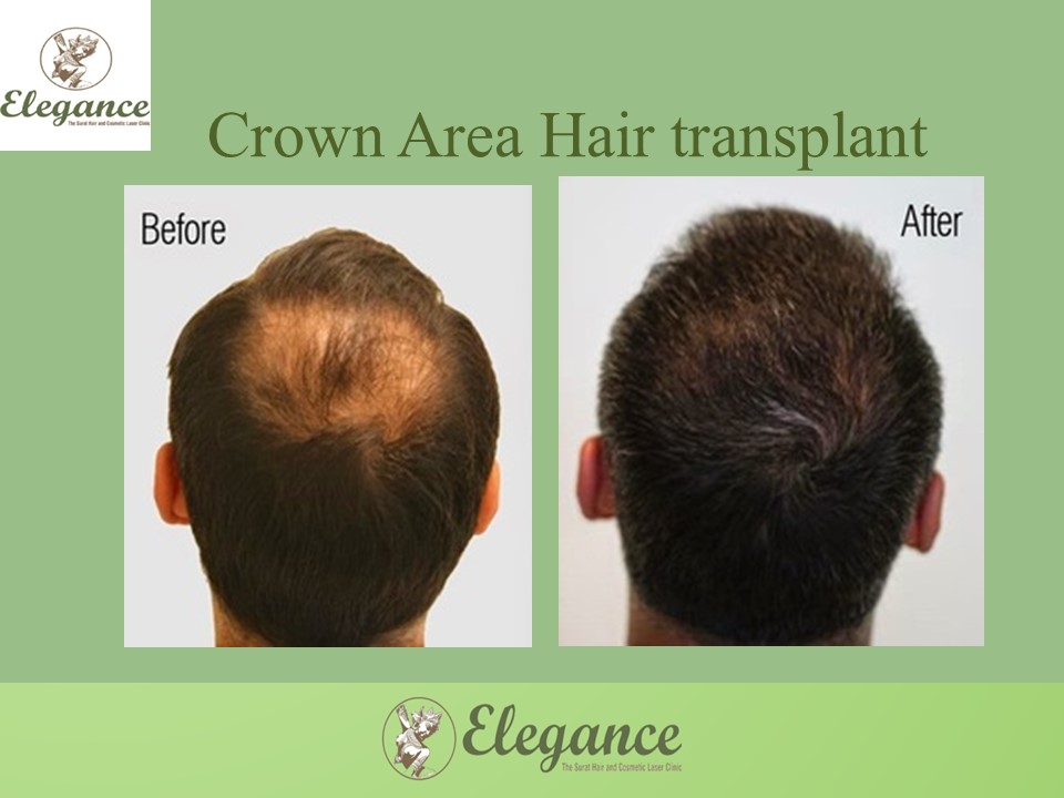 Crown Hair Transplant Treatment, Bardoli, Gujarat, India.
