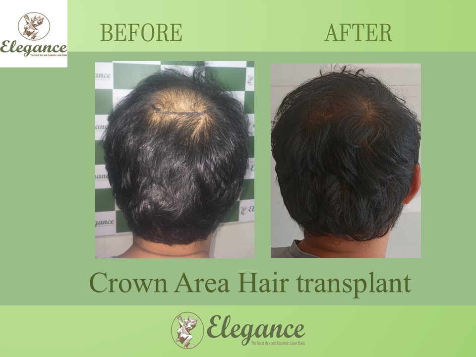 Crown Hair Transplant Treatment, Chikhli, Gujarat, India.