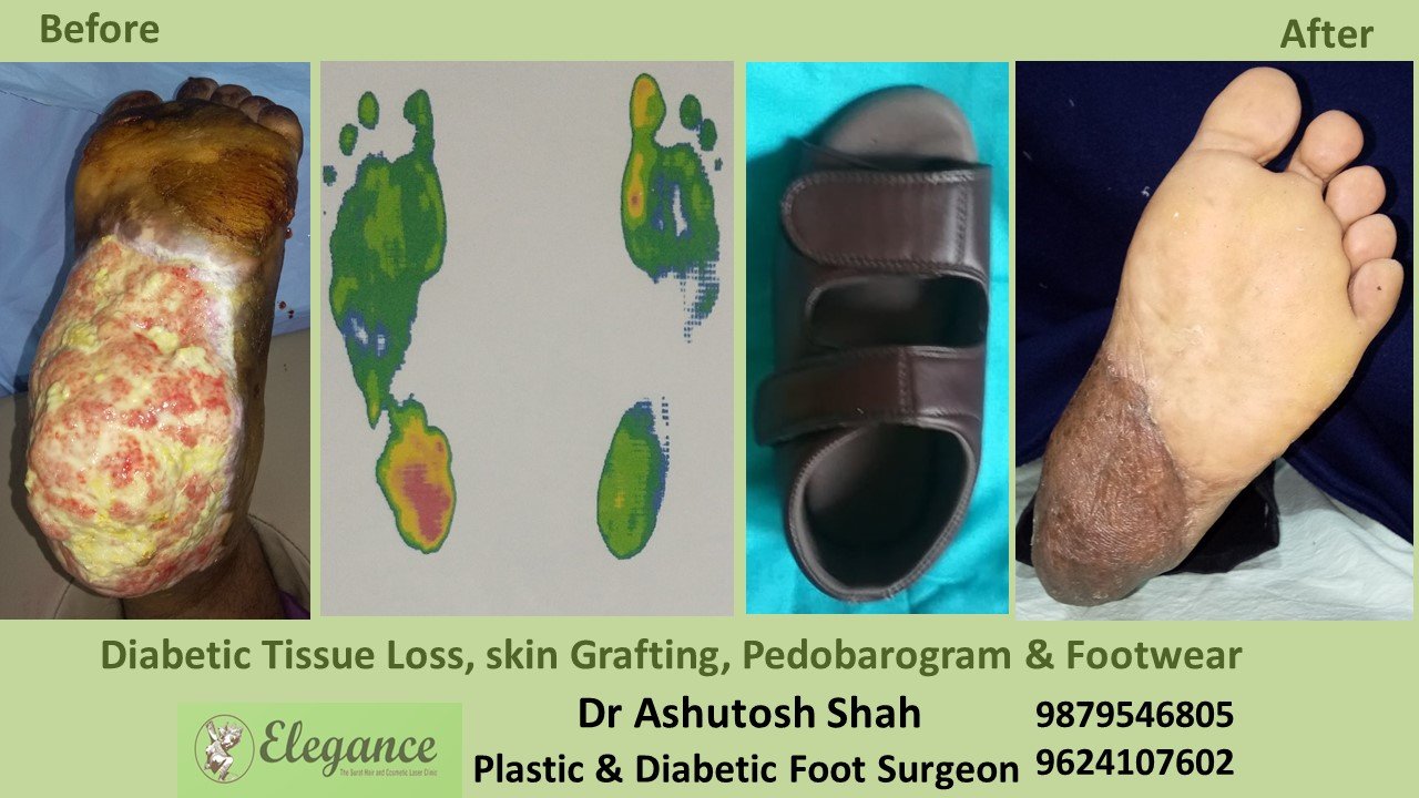 Diabetic Foot ulcer Treatment in Navsari, Valsad, Gujarat