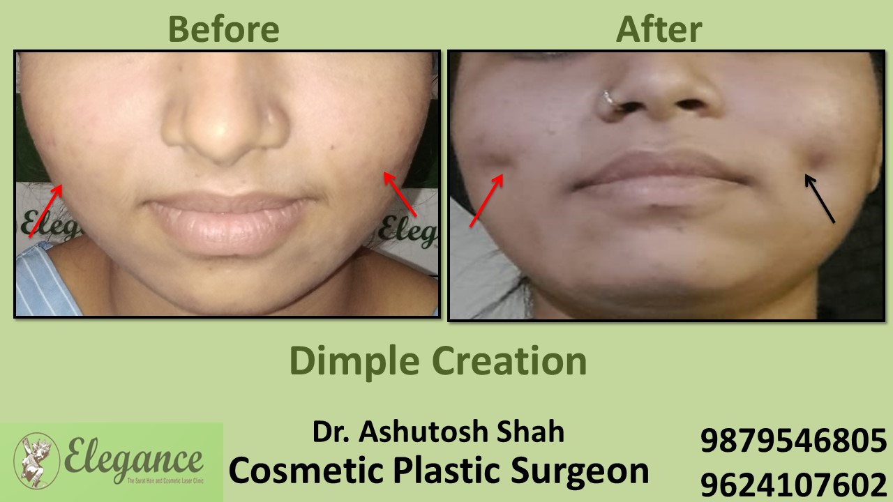 Dimple Surgery in Surat, Gujarat (India)