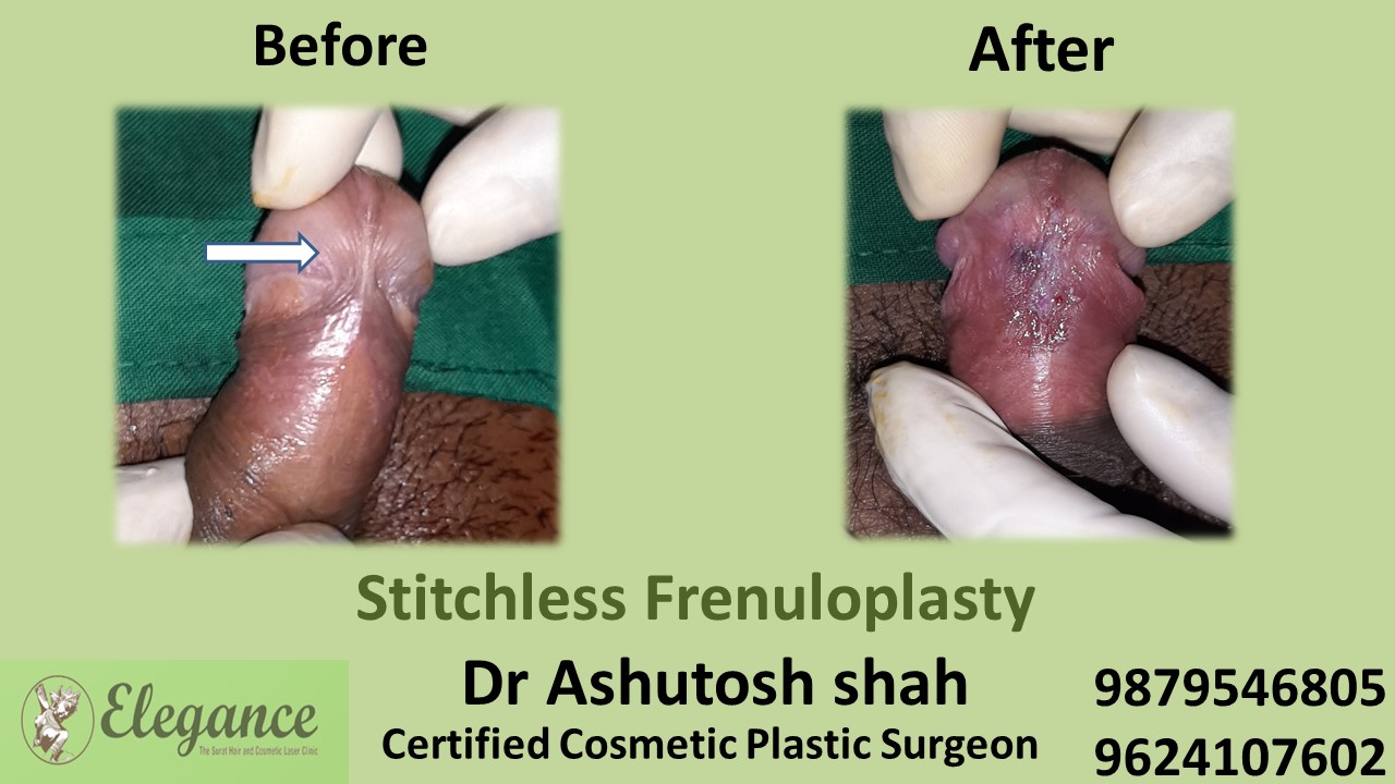 Doctor for Stitchless Frenuloplasty in Gujarat