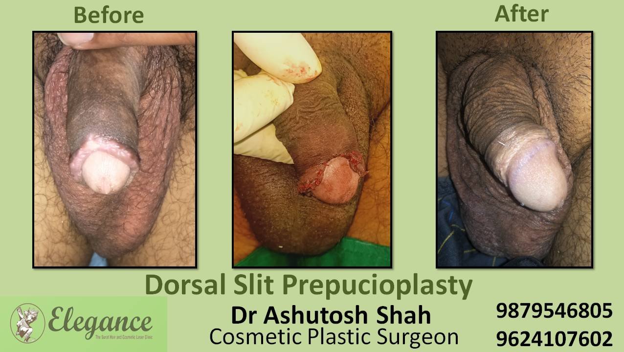 Dorsal Slit Circumcision Surgery