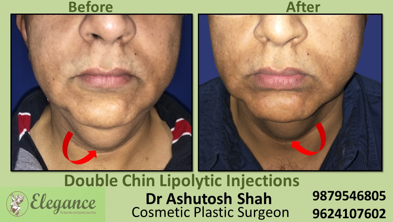 Double chin correction with the help of Injection in  Kim, Vapi, Surat