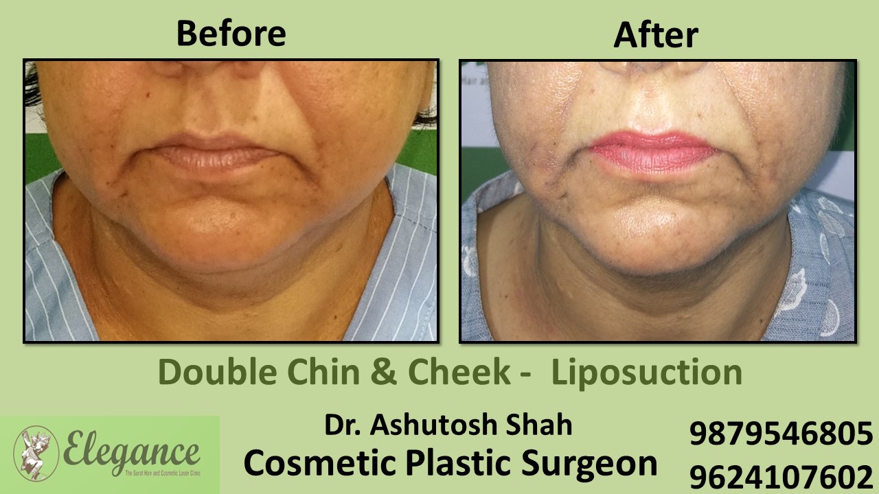 Double Chin Liposuction Surgery, Bardoli, Gujarat, India.