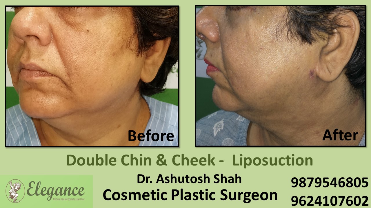 Double Chin Liposuction Surgery, Bharuch, Gujarat, India.