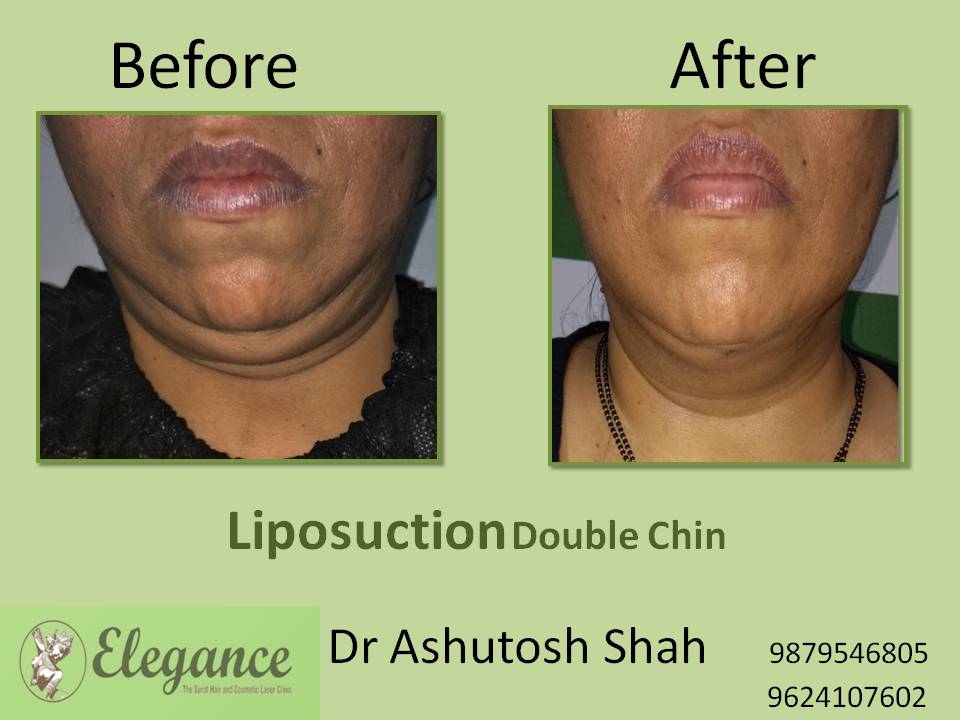 Double Chin Liposuction Surgery, Valsad, Gujarat, India.