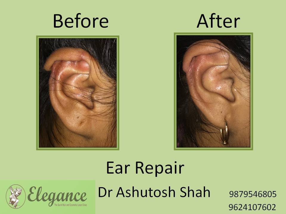 Ear Lobe Treatment in Bharuch, Gujarat