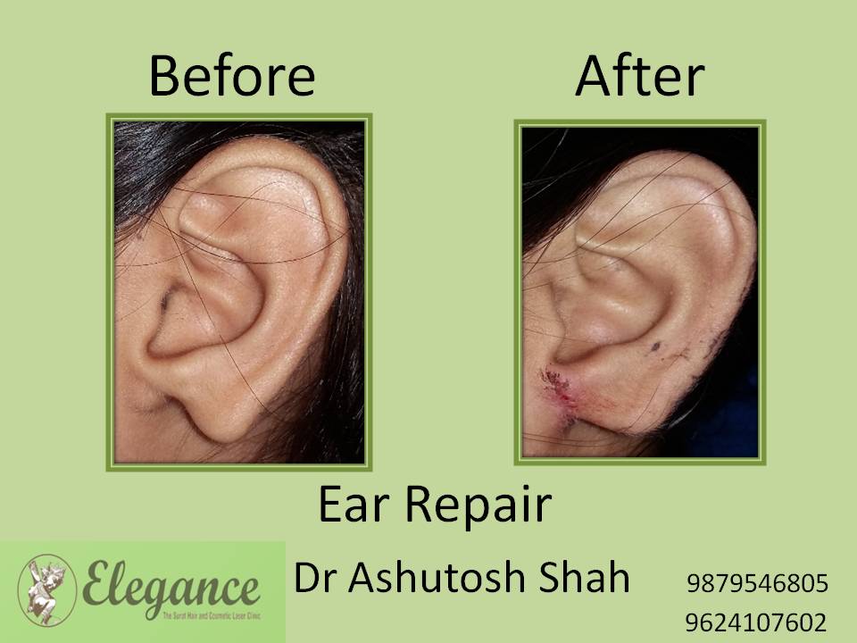 Ear Lobe Repair Treatment in New Sangvi, Pune