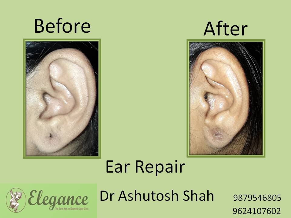 Ear Lobe Treatment in Navsari, Gujarat