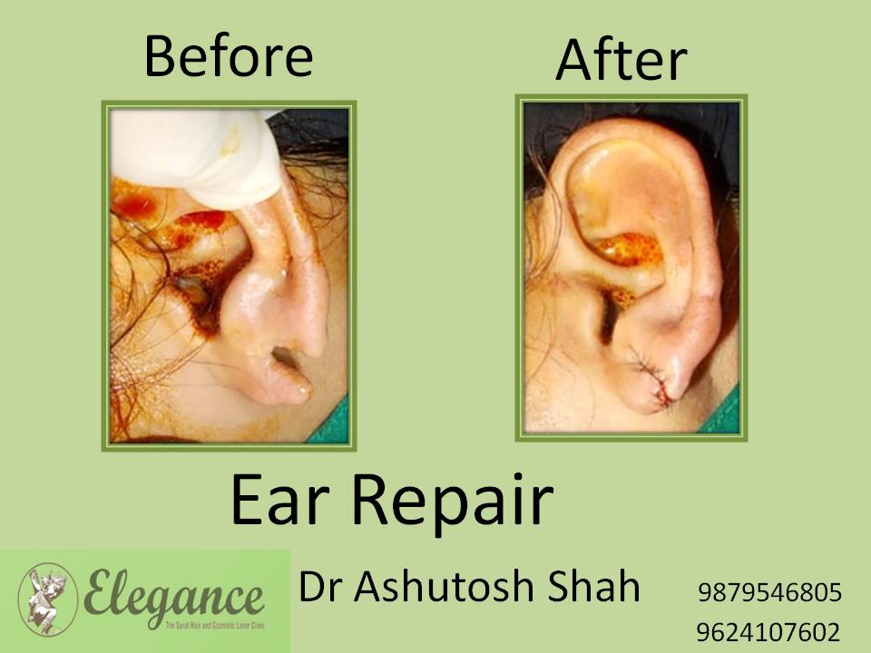 Ear Lobe Treatment in Surat, Gujarat