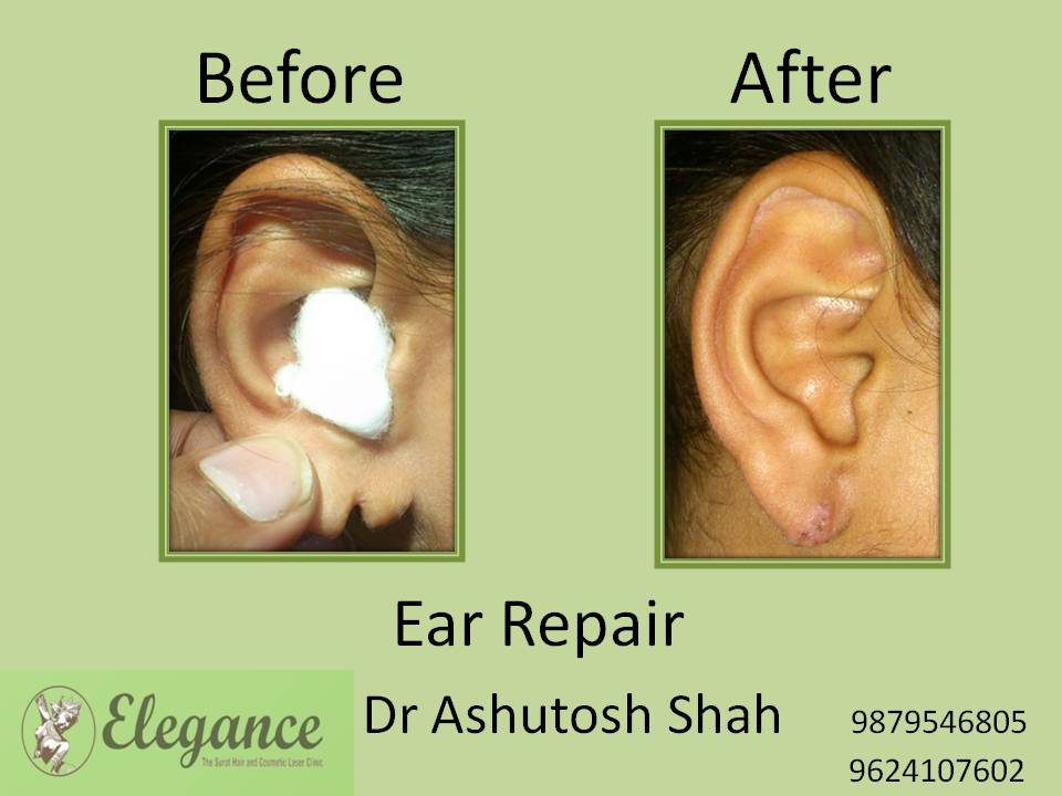 Ear Lobe Treatment in Valsad, Gujarat