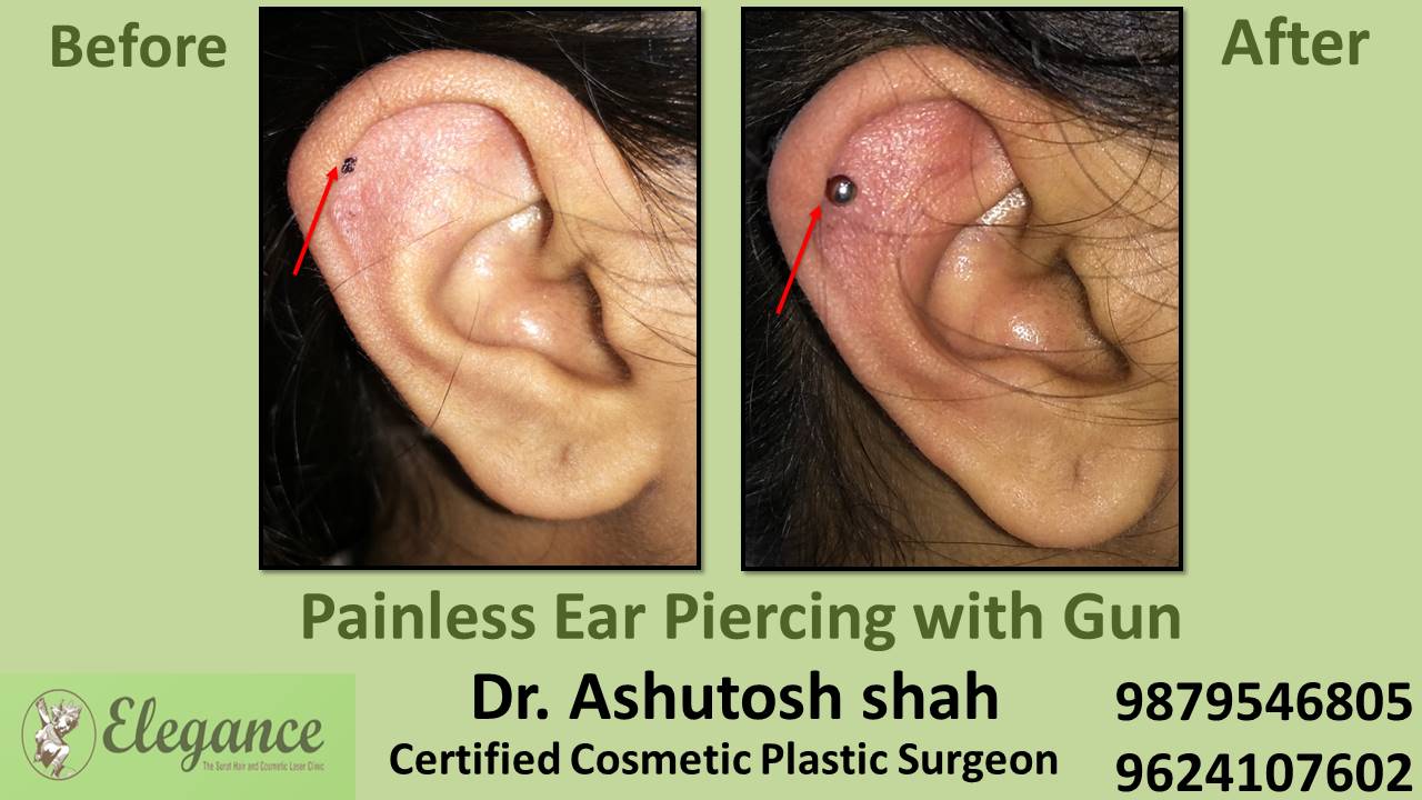 Ear Pearcing Surgery, Bardoli, Gujarat, India