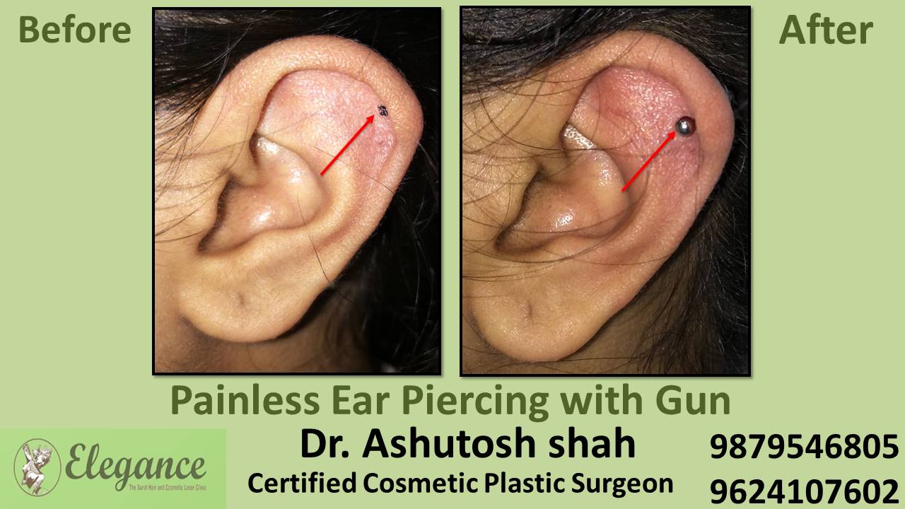Ear Piercing in Surat, Gujarat (India)