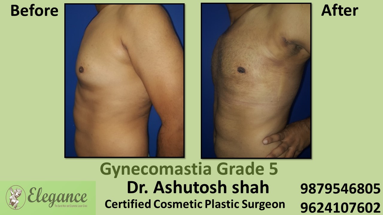 Experts for Male Breast Reduction Surgery in Bilimora, Gujarat