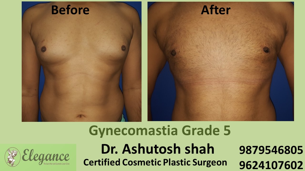 Experts for Male Breast Reduction Surgery in Chikhli, Gujarat