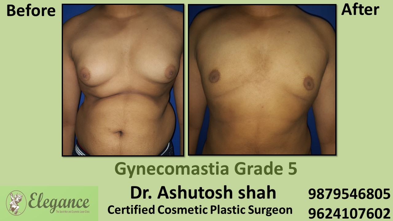 Type 5 Gynecomastia - Significant Breast Roll