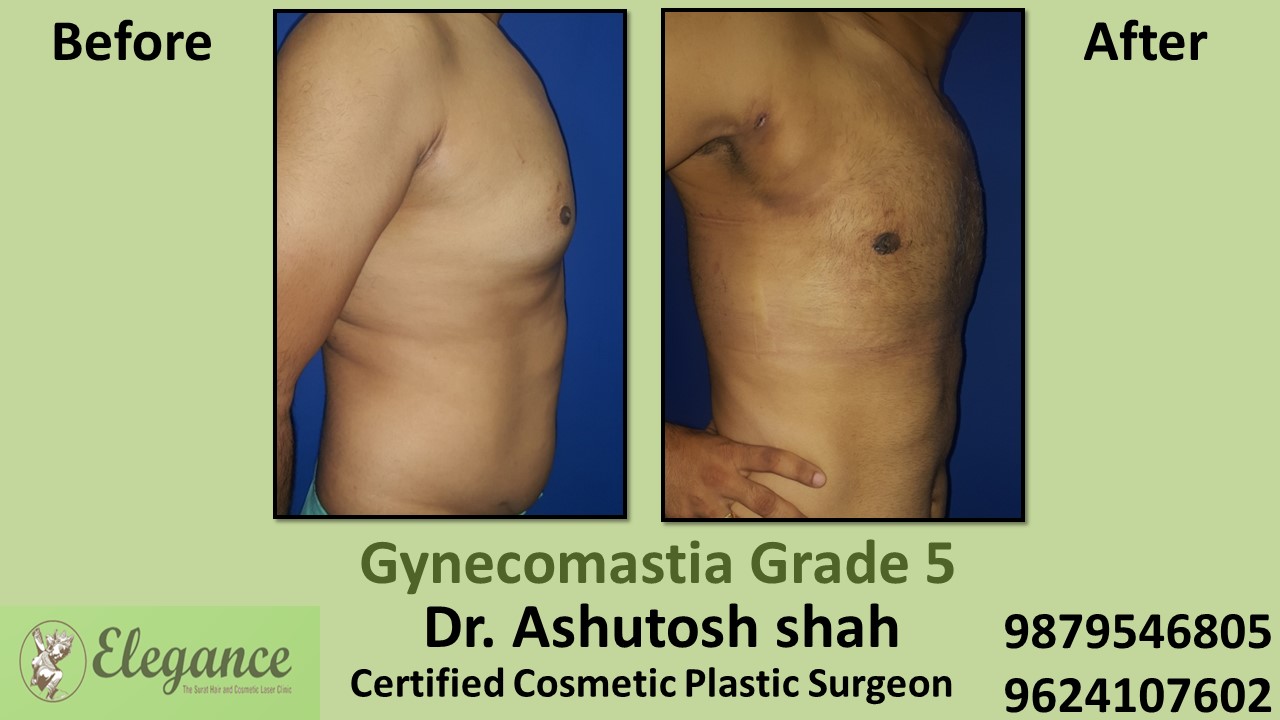 Experts for Male Breast Reduction Surgery in Mangrol, Gujarat