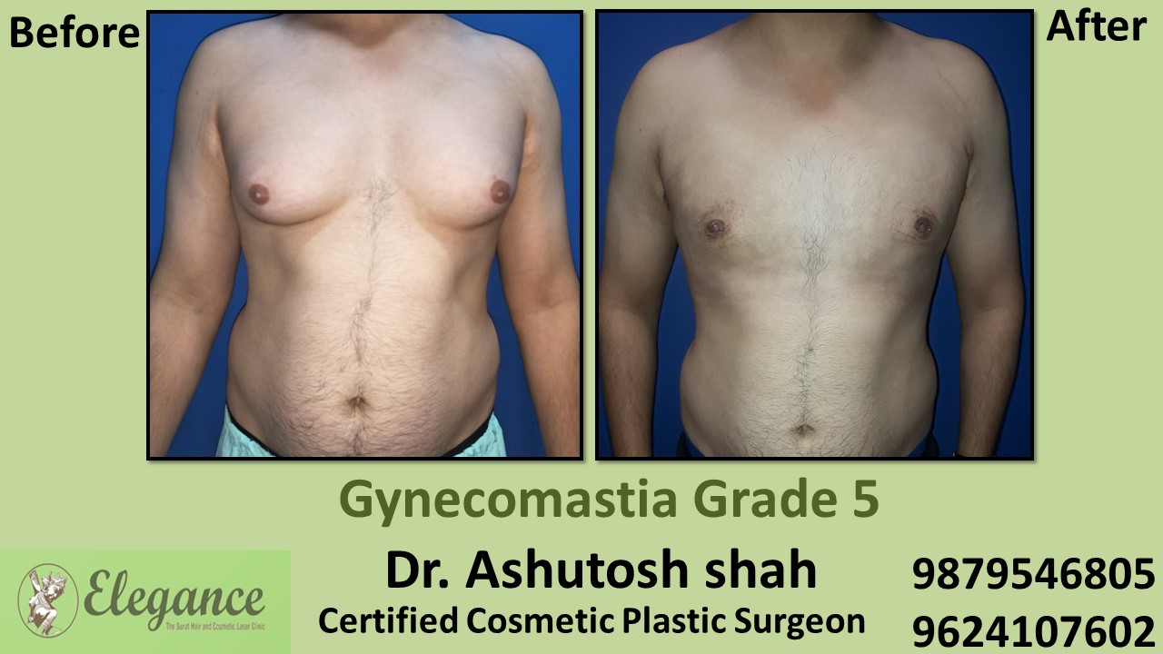 Experts for Male Breast Reduction Surgery in Sivassaa, Gujarat