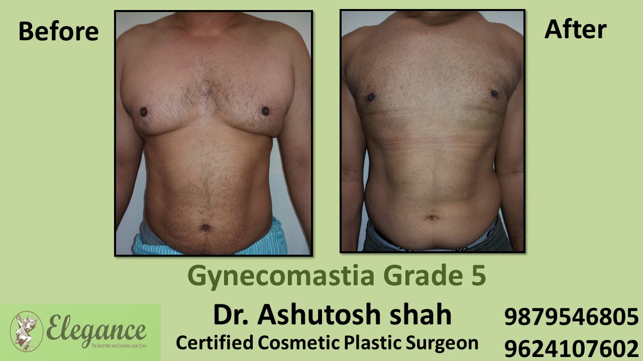Experts for Male Breast Reduction Surgery in Vapi, Gujarat