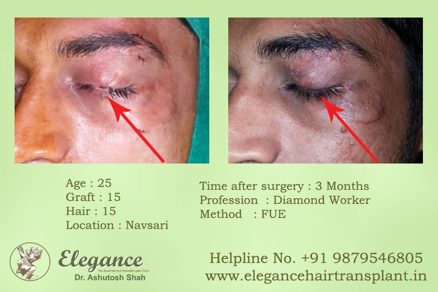 Eye Lash Hair Transplant, Surat, Gujarat, India.