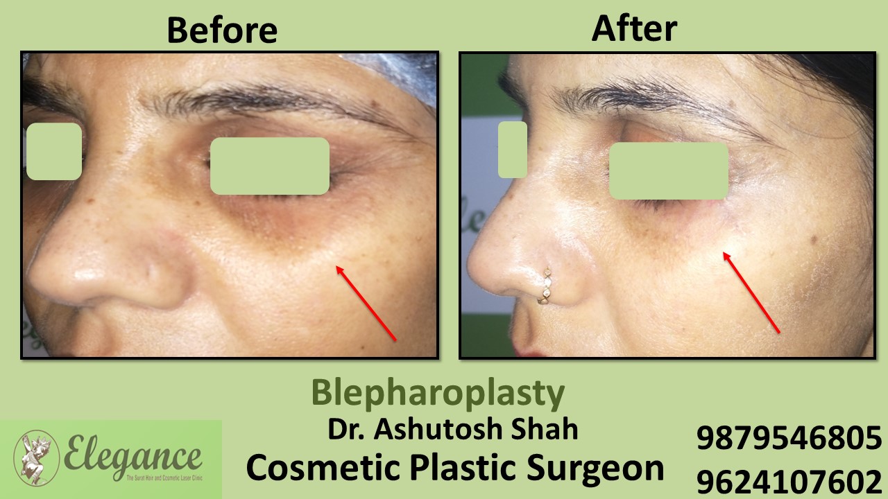 Eyelid Blepharoplasty Surgery Ankleshwar, Gujarat, india.