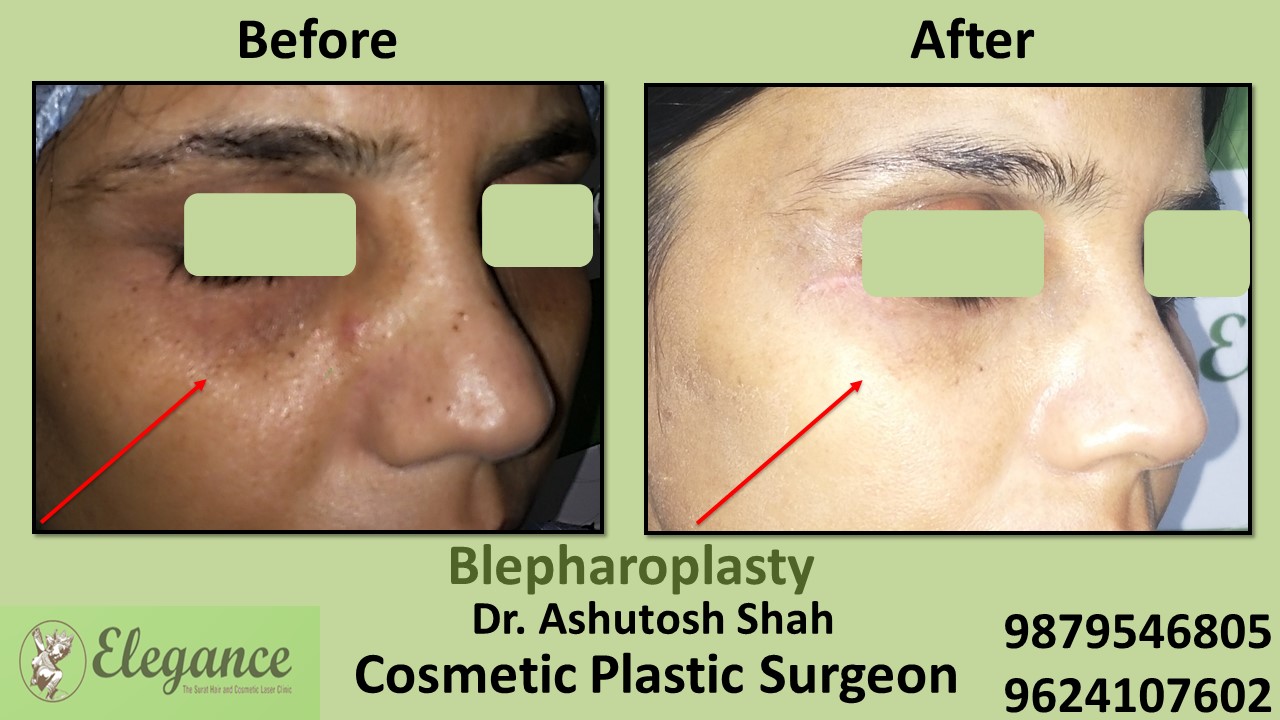 Eyelid Blepharoplasty Surgery Bharuch, Gujarat, india.