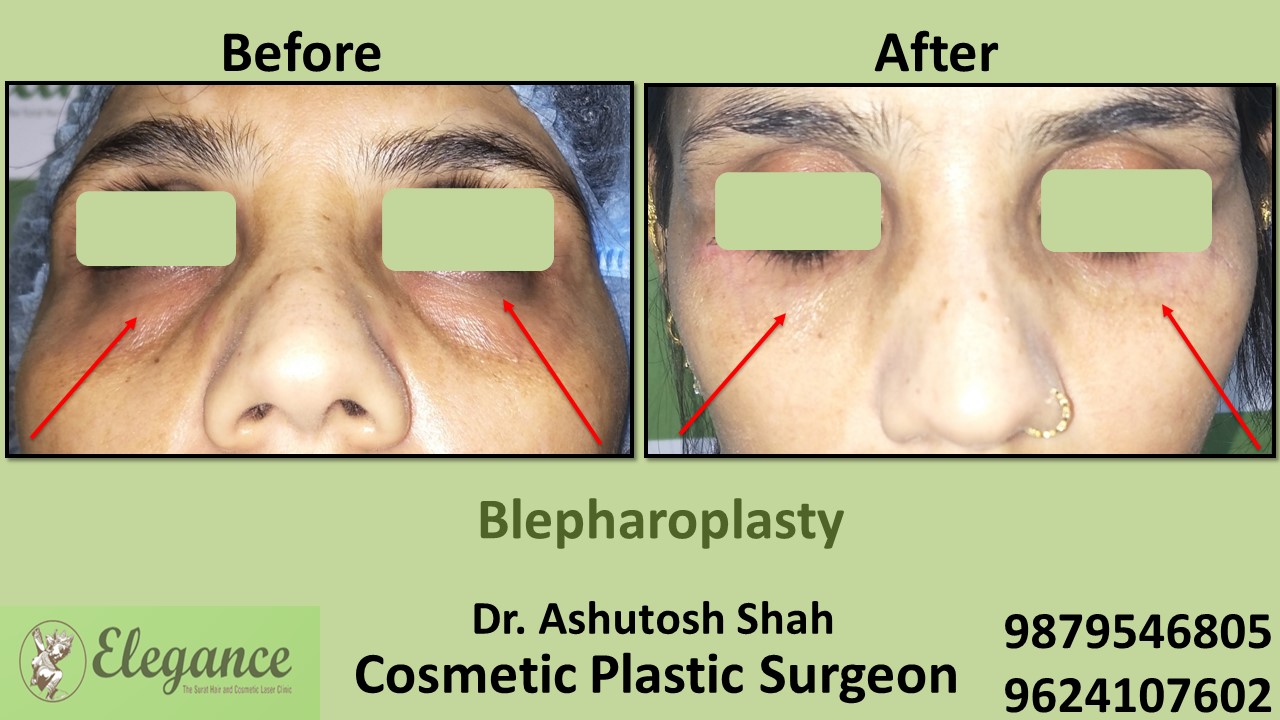 Eyelid Blepharoplasty Surgery Mangrol, Gujarat, india.