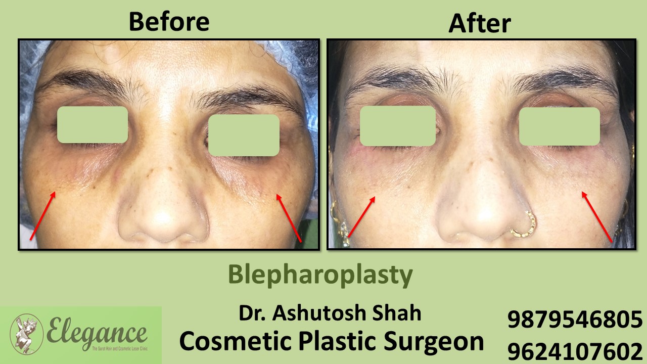 Eyelid Blepharoplasty Surgery Navsari, Gujarat, india.