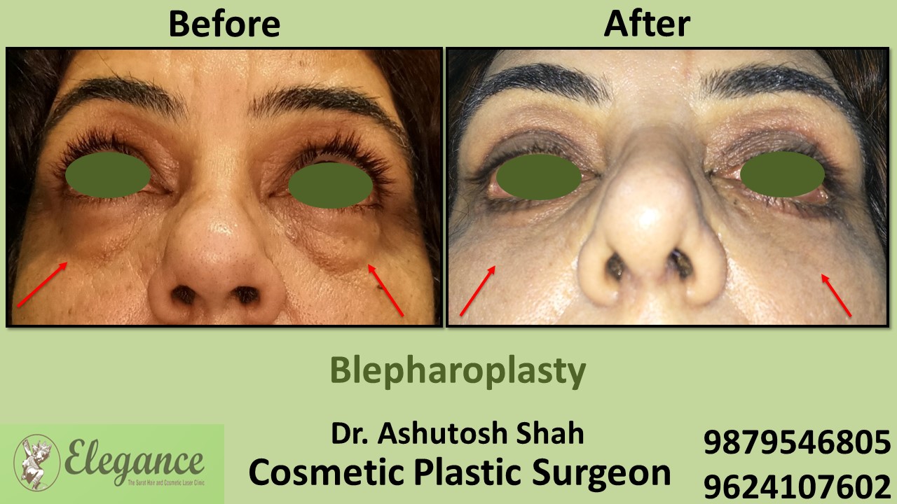 Eyelid Blepharoplasty Surgery Selvasa, Gujarat, india.