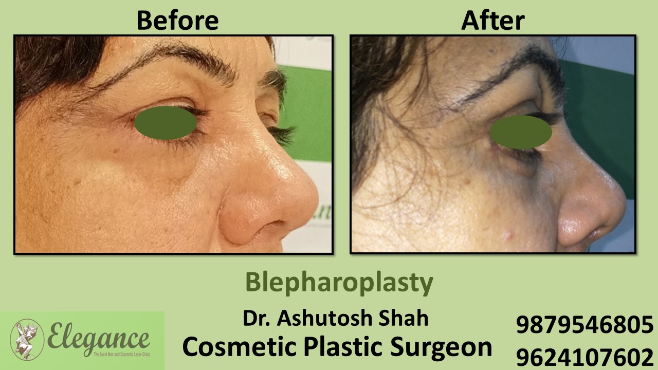Eyelid Blepharoplasty Surgery Valsad, Gujarat, india.