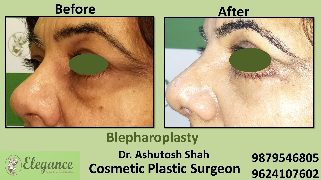 Eyelid Blepharoplasty Surgery Vapi, Gujarat, india.