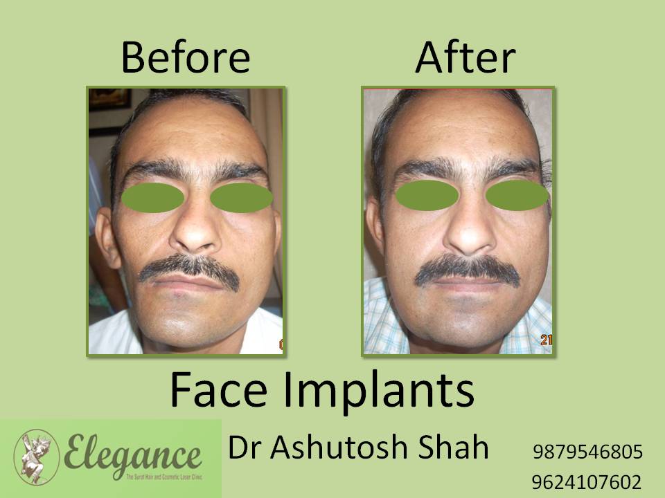 Face Implants Treatment in Surat, Gujarat