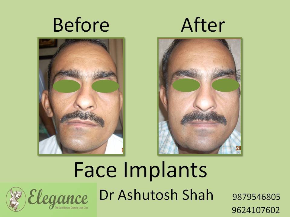 Face Implants Treatment in Surat, Gujarat