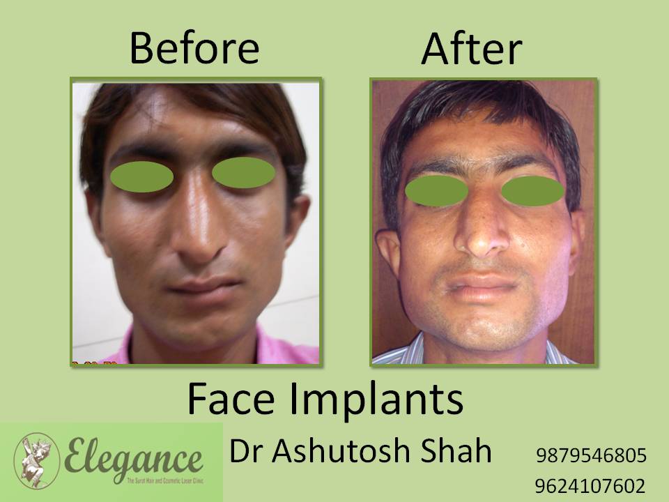 Face Implants TREATMENT in Vadodara, Gujarat