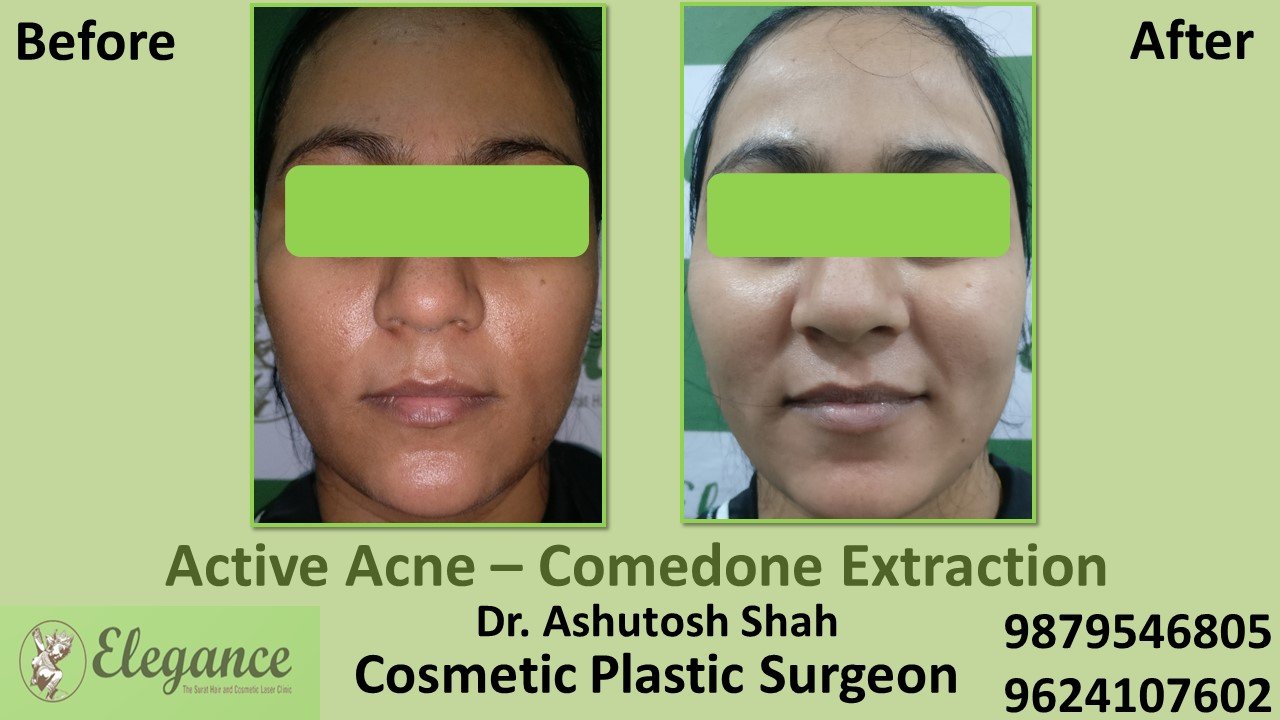 Acne Medical Treatment in Vapi, Navsari, Surat