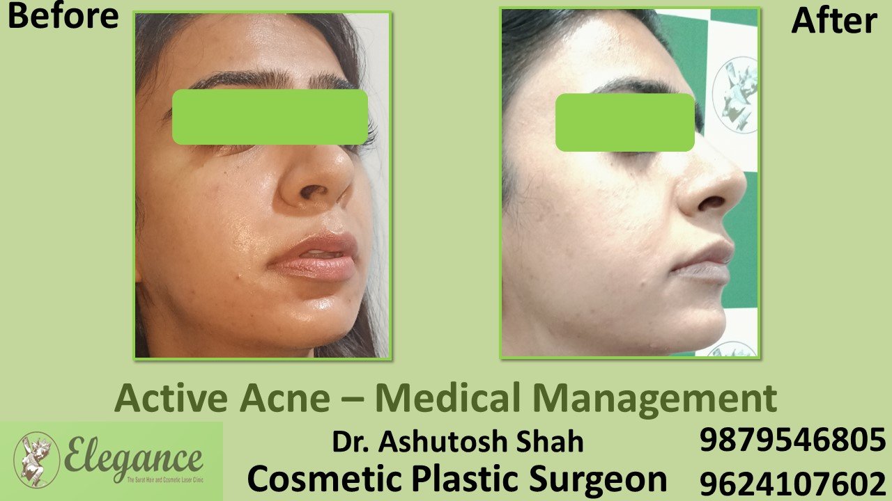 Acne Medical Treatment in Vapi, Valsad, Surat