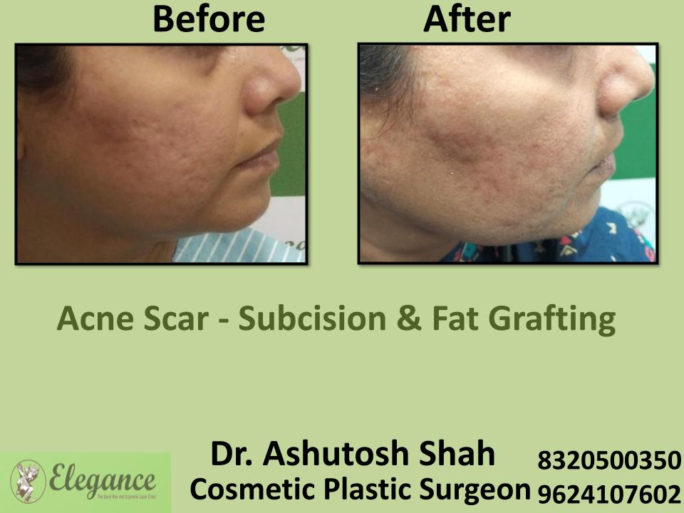 Acne Scar, Fat Grafting Procedure, Uneven Skin Surface, Nnapura, Gopipura, Rander, Surat, Gujarat.