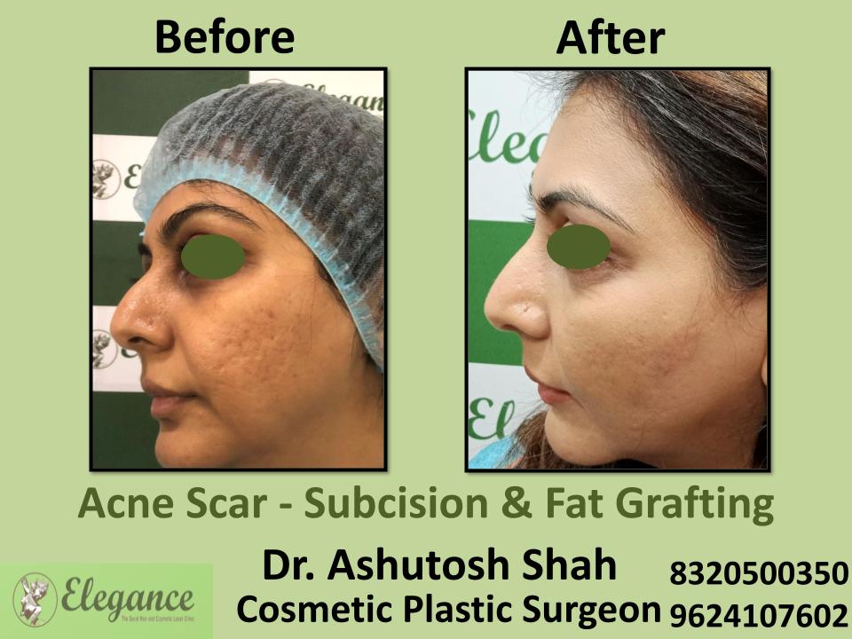 Acne Scar,  Post Acne Marks, Subcision and Fat Grafting, Scar Surgery, Vesu, Piplod, Vesu, Umra, Surat, Gujarat.