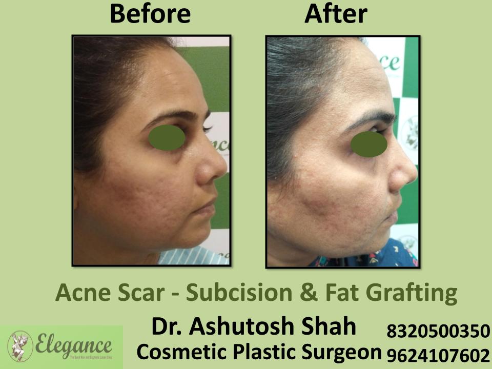 Acne Scar, Raised Scars, Pigment Bad Skin, Treatments And Creams, Pal, Adajan, Sarthana, Surat, Gujarat.