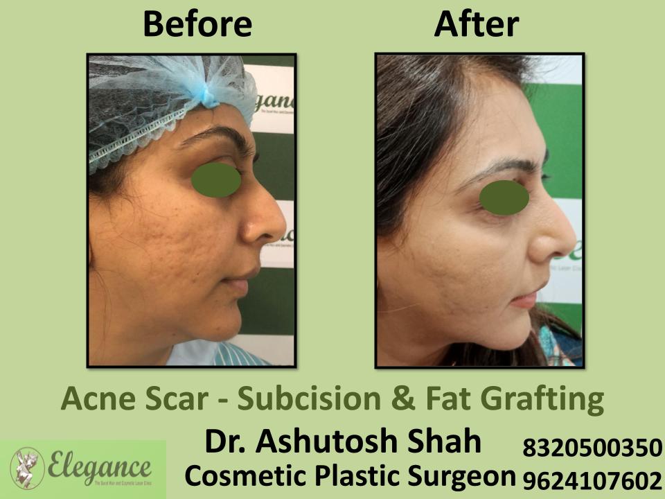 Acne Scar, Subcision and Fat Grafting, Laser Resurfacing, Marks Left on face, Majura, Pandesara, Udhna, Bhatar, Surat, Gujarat.