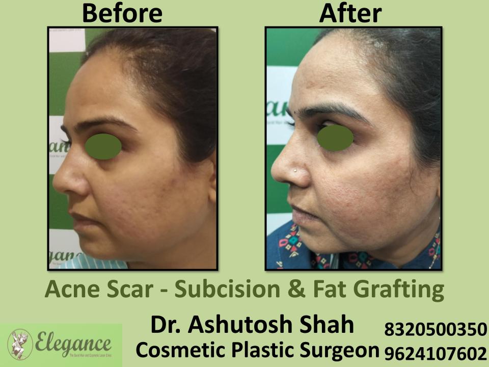 Acne Scar, Subcision and Fat Grafting, Post Acne Marks, Scar Surgery, Piplod, Majura, Pandesara, Surat, Gujarat.