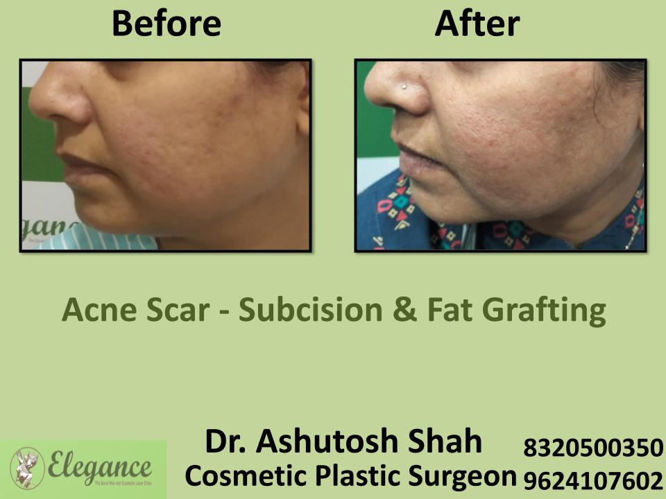 Acne Scar, Subcision and Fat Grafting, Raised Scars, laser Treatment, Majura, Athwa, Bhatarna, Vesu, Surat, Gujarat.