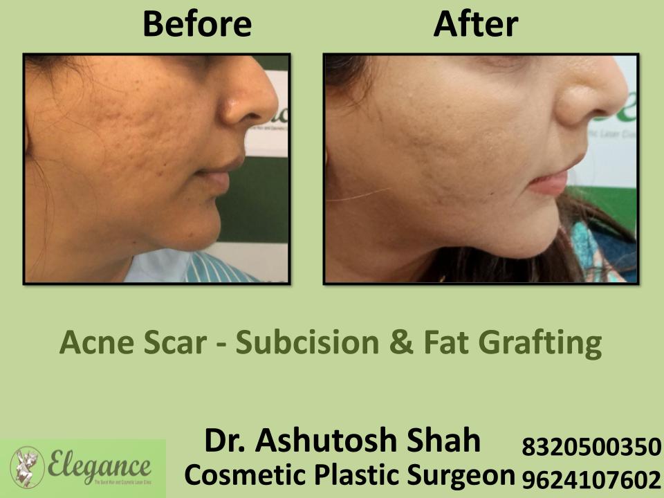 Acne Scar, Subcision and Fat Grafting, Skin Imperfection, Sarthana, Udhna, Dindoli, Piplod, Surat, Gujarat.