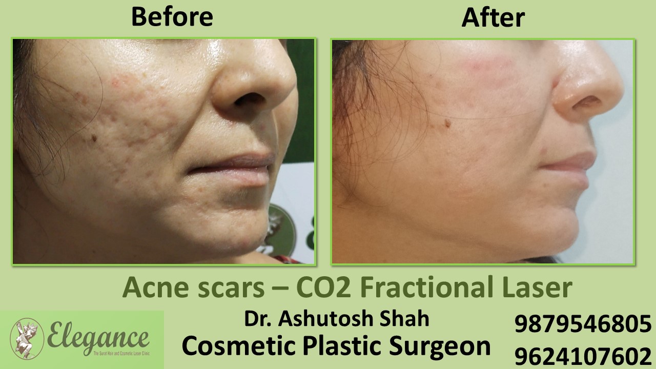 Acne scars- Co2 Fractional Laser Treatment in Bardoli, Surat