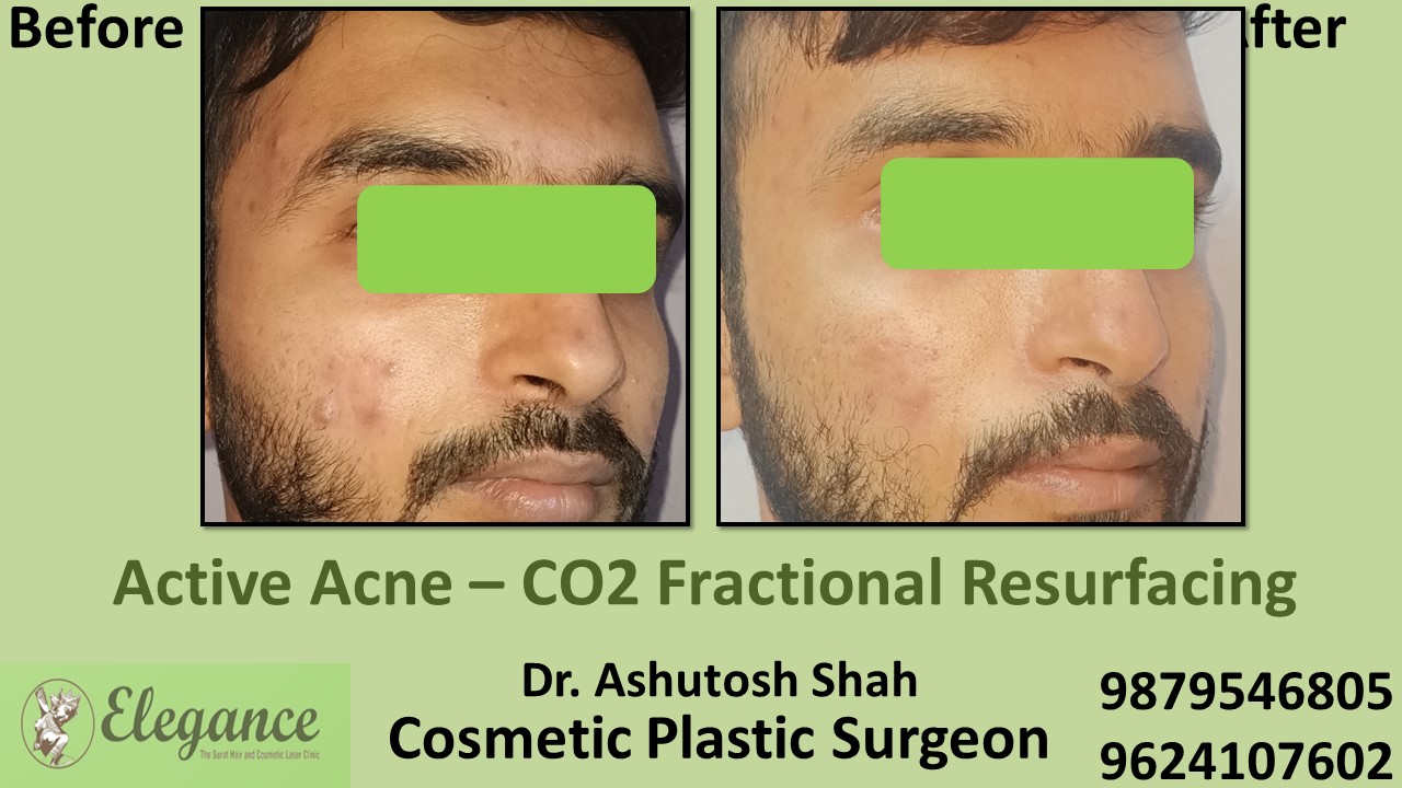 Acne scars- Co2 Fractional Laser Treatment in Bilimora, Vapi, Surat