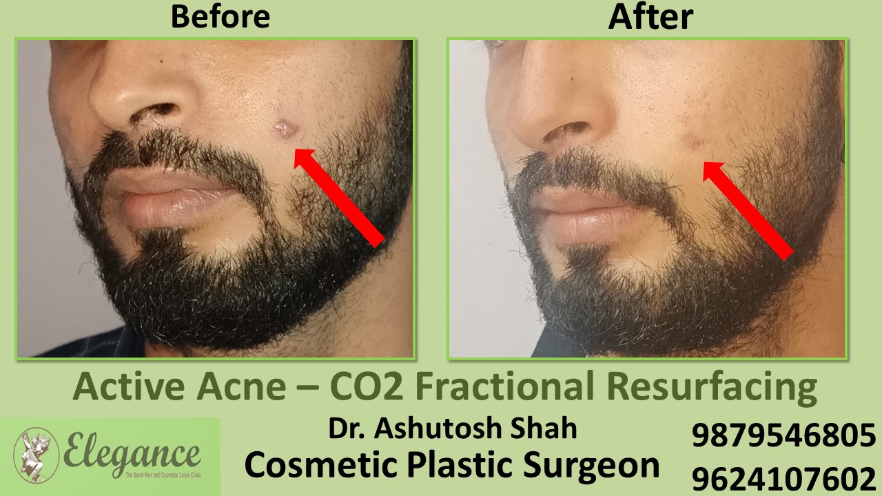 Acne scars- Co2 Fractional Laser Treatment in Kim, Vapi, Surat