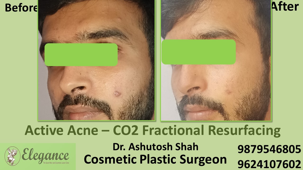 Acne scars- Co2 Fractional Laser Treatment in Kosamba, Kim, Surat