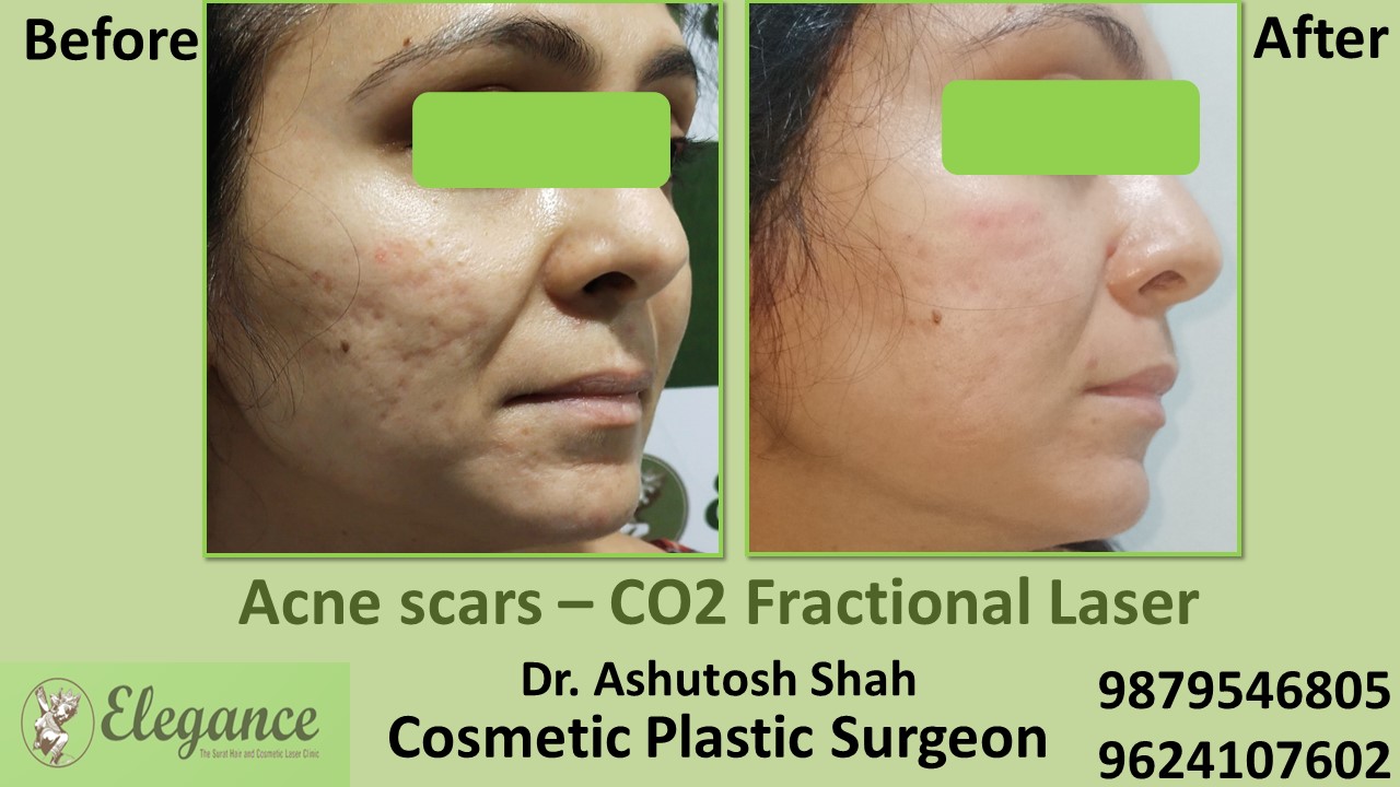 Acne scars- Co2 Fractional Laser Treatment in Navsari, Surat