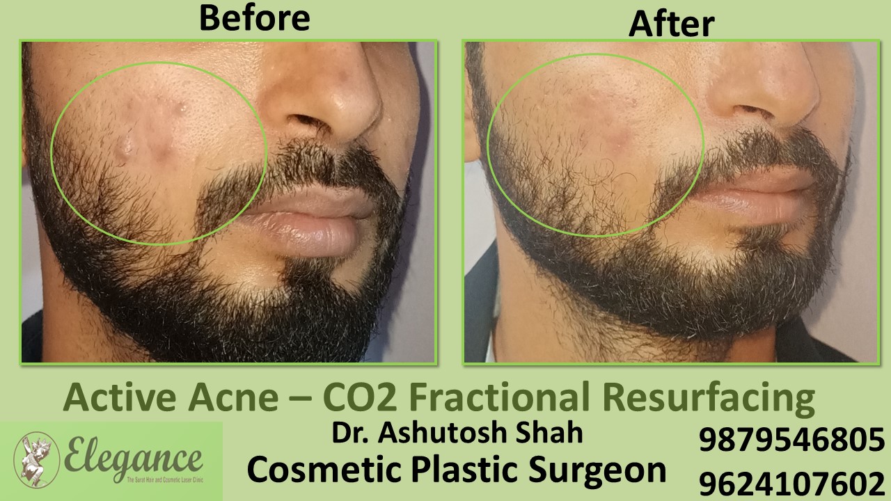 Acne scars- Co2 Fractional Laser Treatment in Olpad, Vapi, Surat